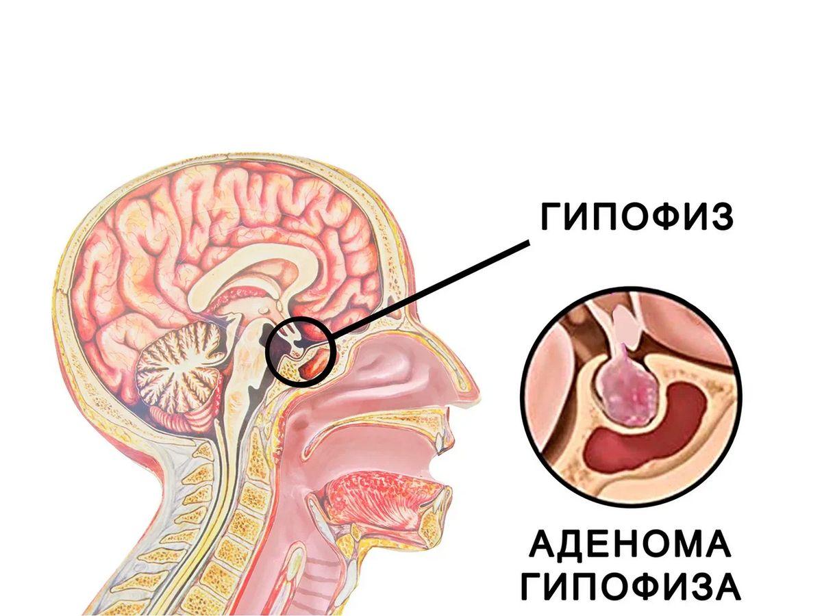 Вы сейчас просматриваете Аденома гипофиза