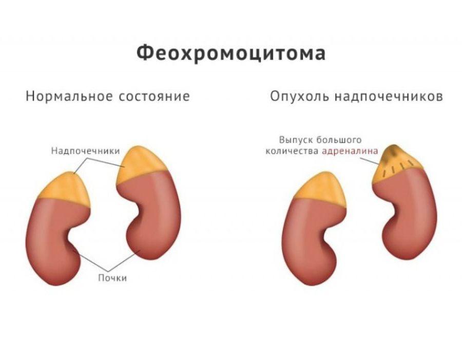 Вы сейчас просматриваете Феохромоцитома: симптомы, диагностика, лечение